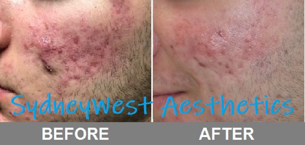 Acne Image -5c6eaae7a1df5